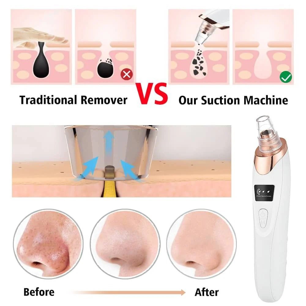 Blackhead Removal Machine – Skin Care & Pore Cleaner - AuraVibezs.store