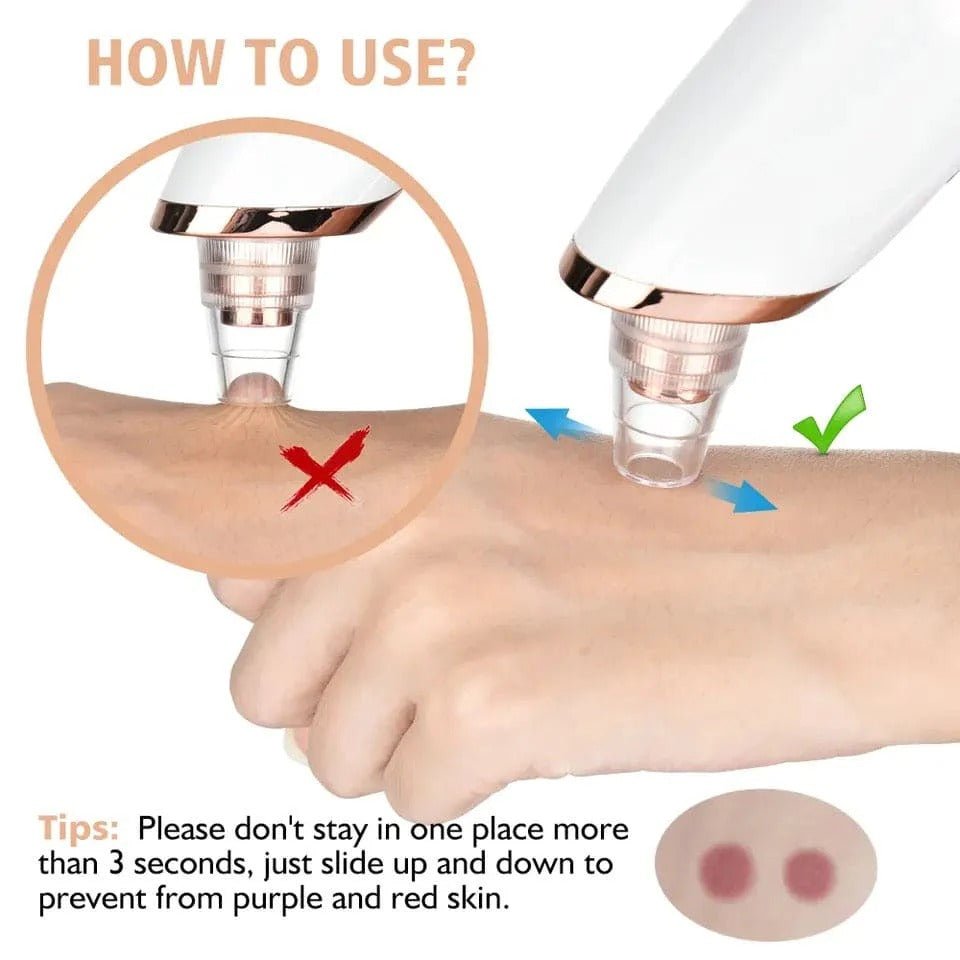 Black head Remover - 5 in 1 Rechargeable Blackhead Remover - Acne Remover - Vacuum Suction - AuraVibezs.store